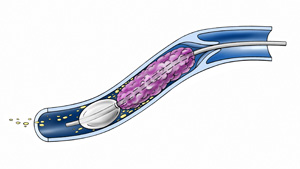 Verstopft die frische Thrombose eine Beckenvene und/ oder die tiefe Oberschenkelvenen, dann treten in den meisten Fällen in kurzer Zeit starke Beschwerden wie Schwellungsneigung, Schweregefühl, Hautveränderungen usw. auf.