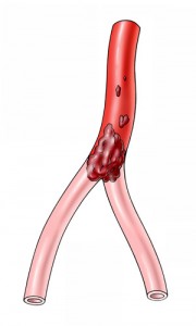 Embolischer Verschluss einer Arterie führt zu plötzlich auftretenden Schmerzen. Umgehungskreisläufe sind meistens noch nicht ausgebildet. 