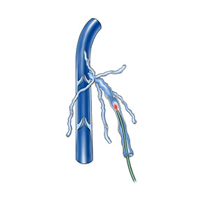Bei den endovenösen Kathetertechniken (Laser, Radiofrequenz, Dampf) wird die oberflächliche Stammvene im Bein belassen und mit Energie (Wärme) verschlossen.