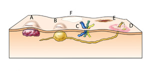 Komplikationen nach minimal invasiven chirurgischen Eingriffen