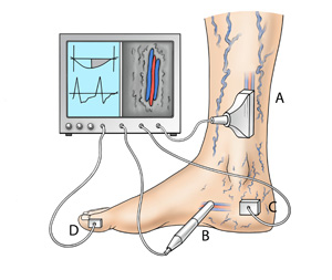 Krampfadern werden mit der Farbultraschall Untersuchung (A) mit Bild- und Flussdarstellung oder mit der Dopplersonde (B) nur mit Flussdarstellung abgeklärt. Der gesamte Venenabstrom wird mit der Lichtreflexionsrheographie (LRR) (C) gemessen. Die arterielle Durchblutung mit der digitalen Oszillographie (D). 