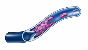 Wird der Blutfluss in den Venen nicht aktiv bewegt, entsteht eine Thrombose. Das Blut kann nicht mehr abfliessen und staut zurück. Dadurch entsteht eine Schwellung Wird ein Stück der Thrombose gelöst und durch das Herz in den Lungenkreislauf gepumpt, droht eine lebensgefährliche Lungenembolie. 