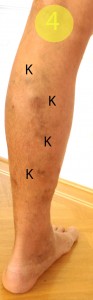 Trotz zweimaliger Operation zunehmende Braunverfärbung (H), Hautveränderung, Schwellungsneigung und Hervortreten von teilweise überwärmten Krampfadern (K) am linken Unterschenkel.