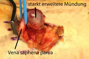 Intraoperativer Befund der stark erweiterten Mündung der Vena saphena parva mit Möglichkeit von Thromben- und Embolie Bildung (Lungenembolie)