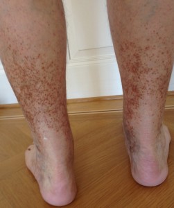Braunverfärbung beider Beine bei langjähriger Blutverdünnung (Marcoumar) infolge Lungenembolie vor vielen Jahren.