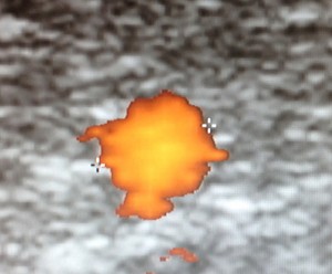 Oberflächliche Stammvene (Vena saphena magna) im weiteren Verlauf auf Kniegelensköhe. Blutfluss in der FKDS Untersuchung rot, Durchmesser deutlich erweitert (0.6cm). Die Stammvene ist auch noch auf Kniegelenkshöhe defekt (insuffizient). 