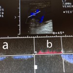 Messung Schweregrad vom venösen Rückfluss (tiefe innere Krampfader) mit der Farbultraschall Untersuchung
