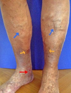 Am Innenknöchel besteht ein Ulcus cruris „offenes Bein“ (roter Pfeil) als langjährige Spätkomplikation nicht therapierter Krampfadern (=chronisch venöse Insuffizienz Stadium lll). Gelber Pfeil: Hautveränderungen (Braunverfärbung, Verhärtung). Blauer Pfeil: grosse schmerzfreie Krampfadern