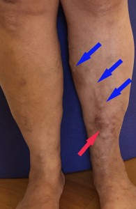 Praetibial Hyperpigmentation